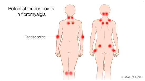 medical illustration showing fibromyalgia tender points