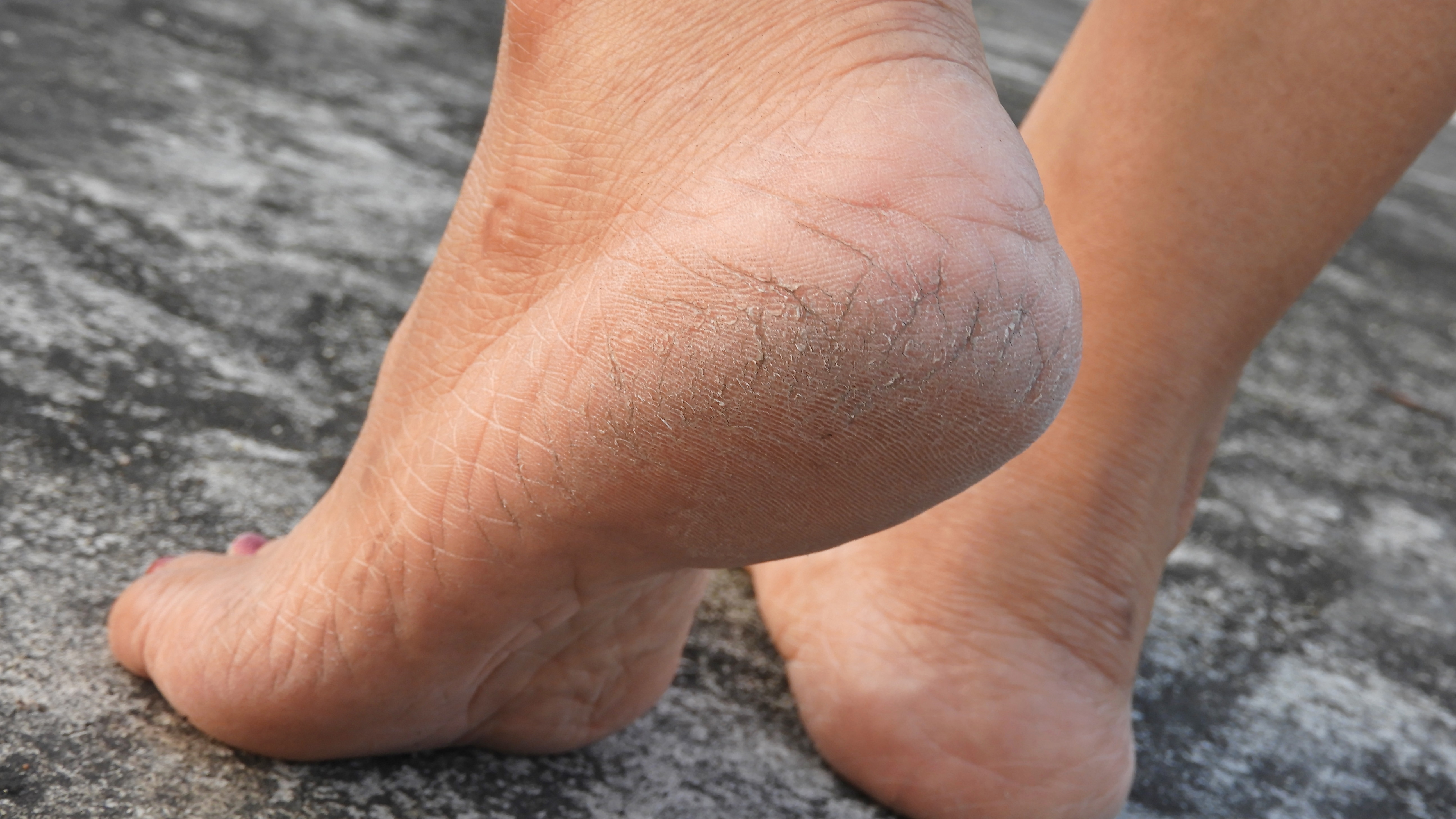Heel Fissures: Treatment, Causes, Prevention | Nailpro