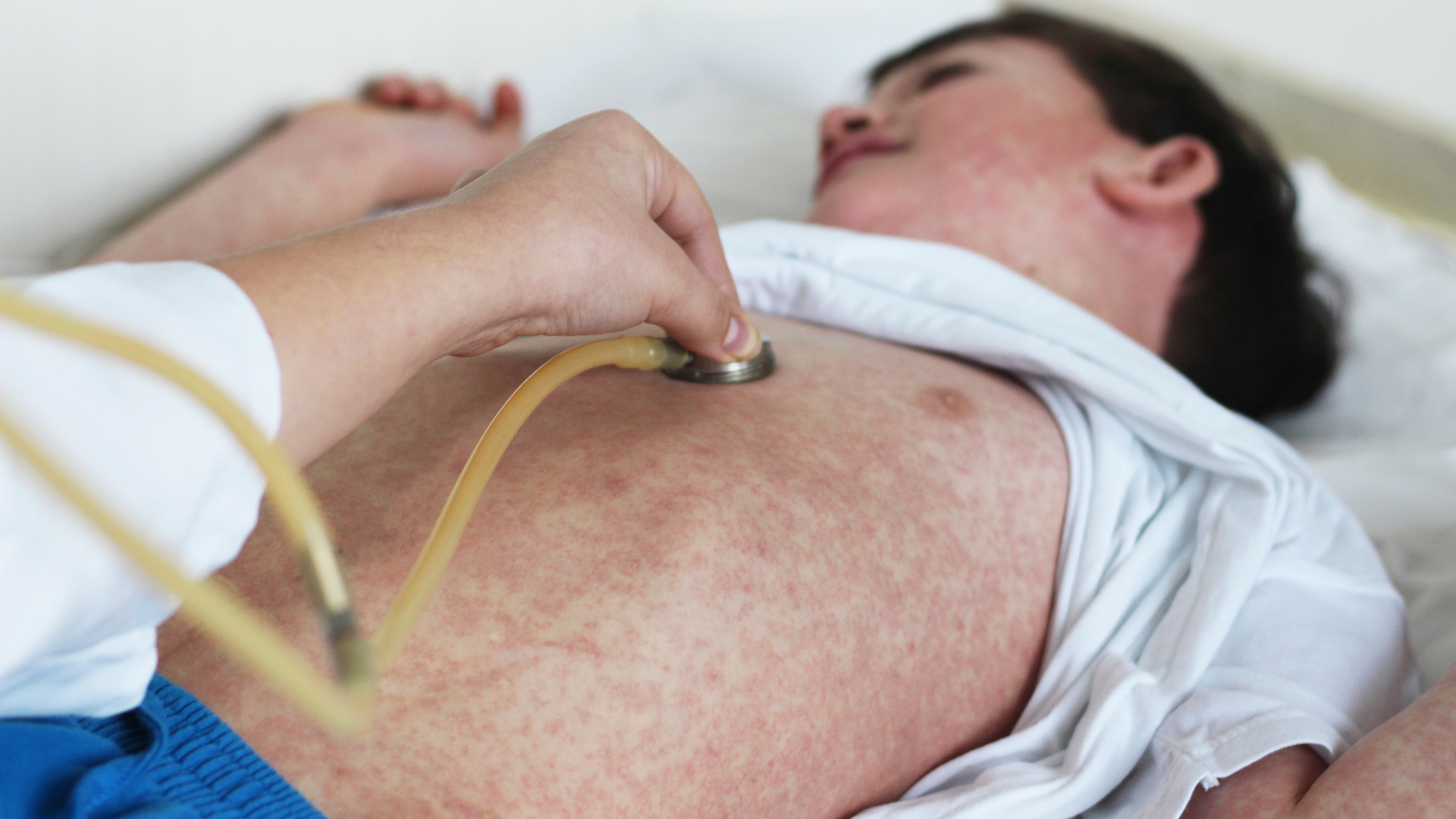a young boy who is sick with the measles virus and being examined by a health care provider