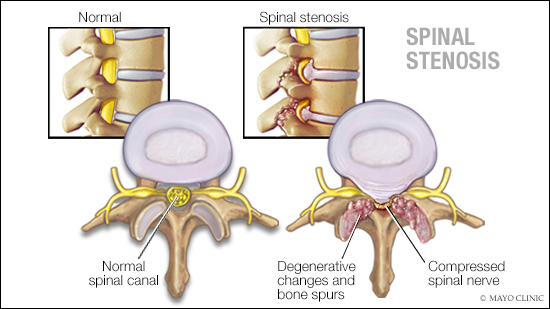 Medical illustration of spinal stenosis