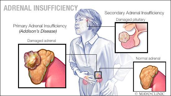 a medical illustration of adrenal insuffiency