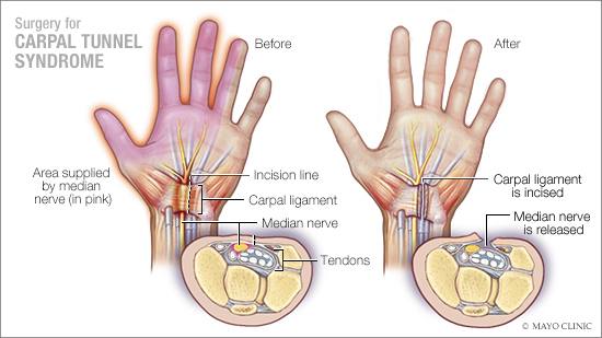 a medical illustration of surgery for carpal tunnel syndrome