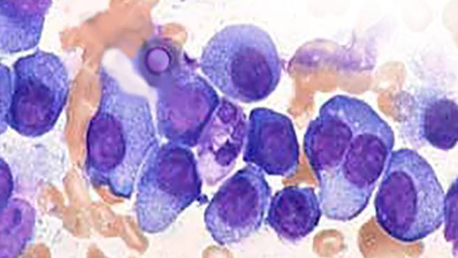 microscopic slide of a myeloma cell