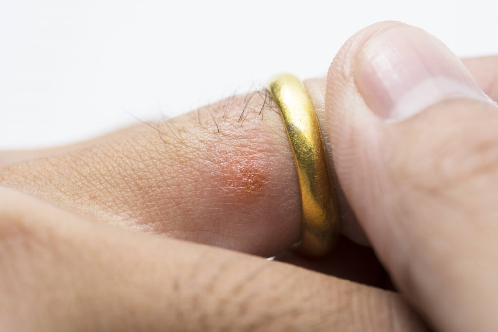 close up of a ring on a person's finger, showing a red skin rash