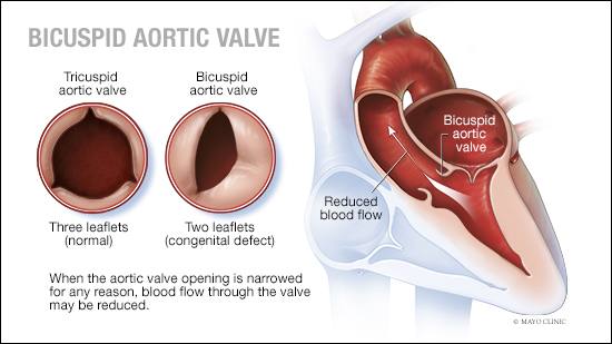 a medical illustration of a normal tricupid aortic valve and a bicuspid aortic valve, which is a congenital defect