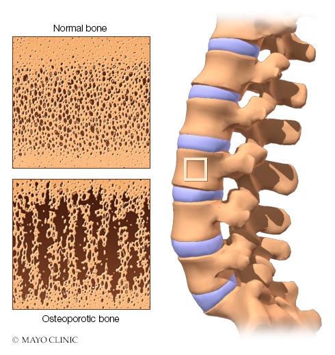 a medical illustration of normal bone and osteoporotic bone, osteoporosis