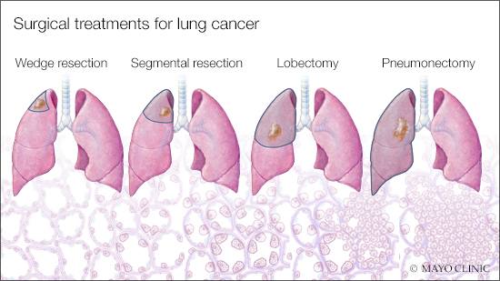a medical illustration of surgical treatments for lung cancer