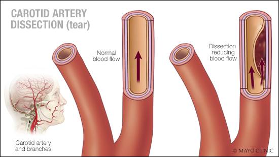 a medical illustration of carotid artery dissection (tear)