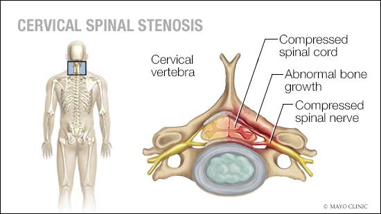 a medical illustration of cervical spinal stenosis