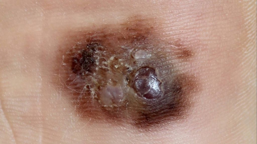 close up of a melanoma plantar on a foot surface