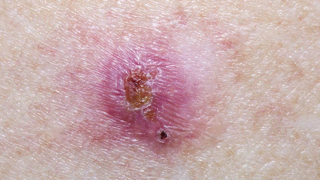 a closeup of a basal cell carcinoma, skin cancer