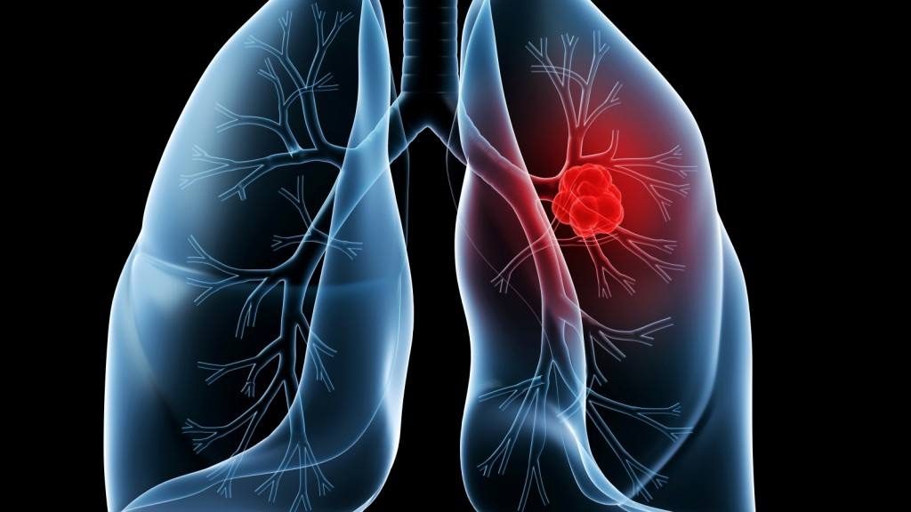 Ilustración de unos pulmones con un tumor canceroso
