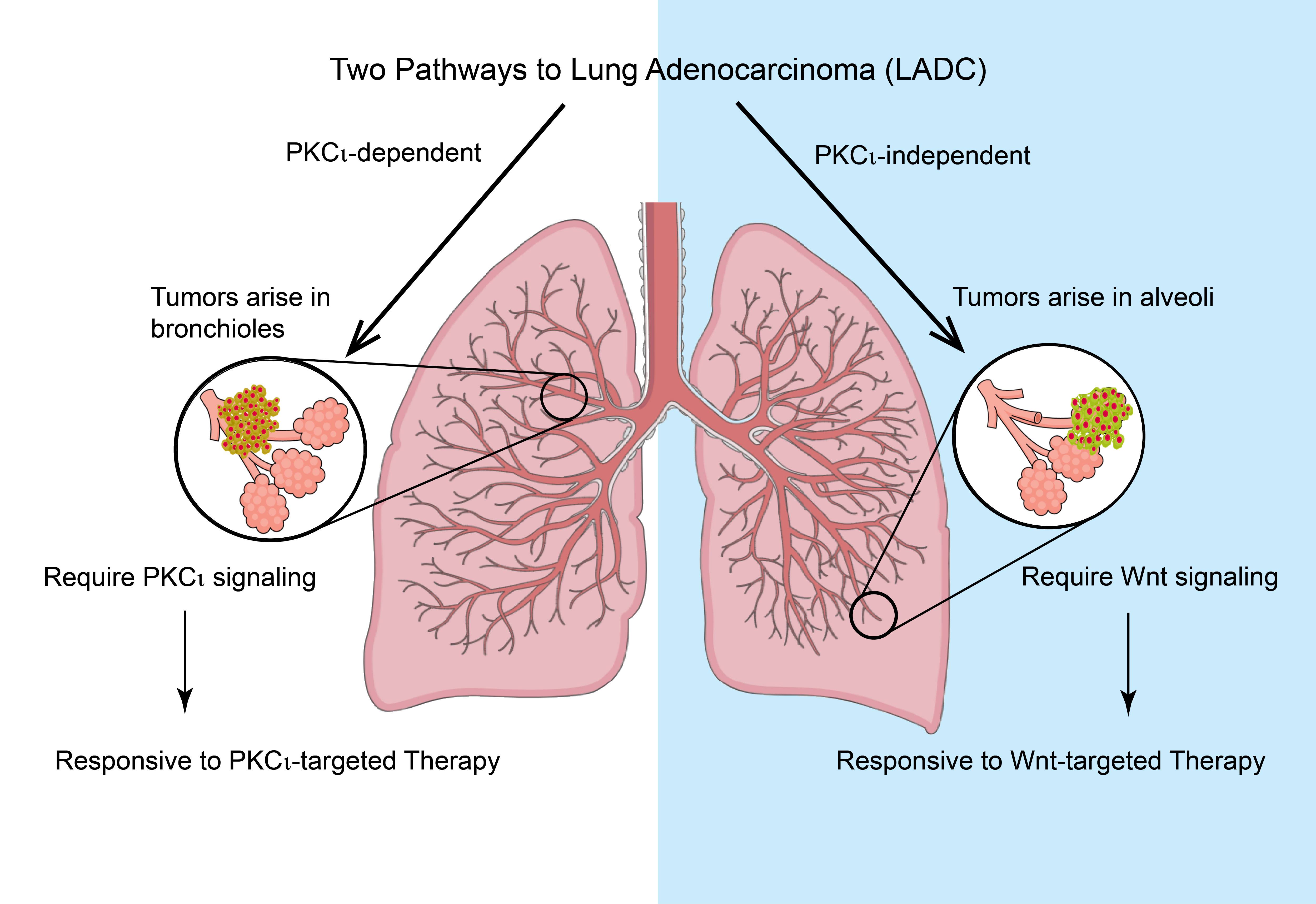 diagram of two pathways to lung adenocarcinoma