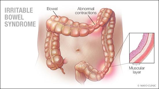 a medical illustration of irritable bowel syndrome