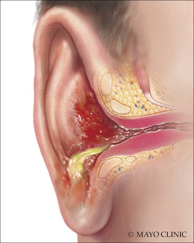 Причины воспаления среднего уха. Диффузный наружный отит.