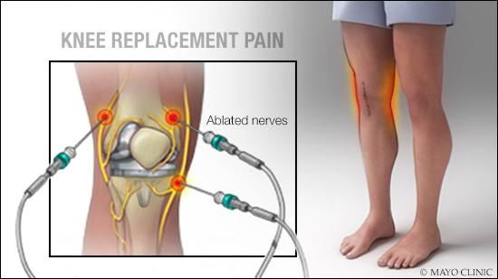 a medical illustration of a nerve ablation procedure for pain after knee replacement