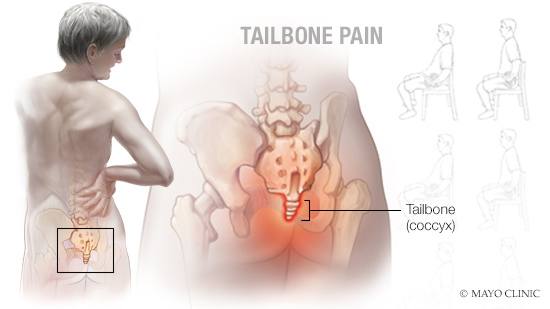 a medical illustration of tailbone (coccyx) pain