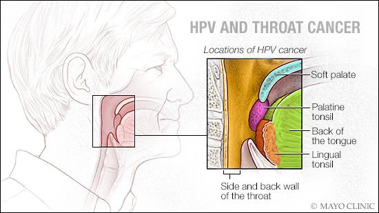 a medical illustration of HPV and throat cancer