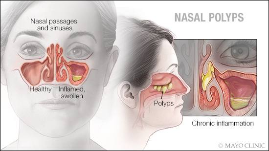 a medical illustration of nasal polyps