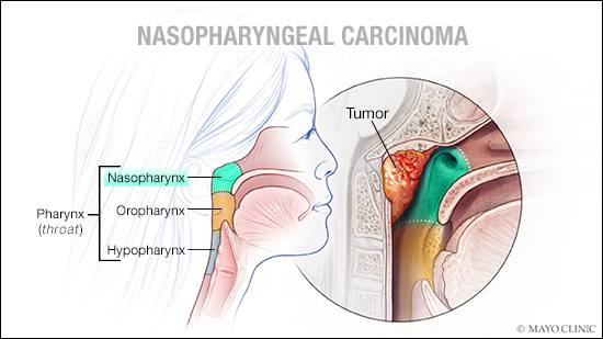 a medical illustration of nasopharyngeal carcinoma