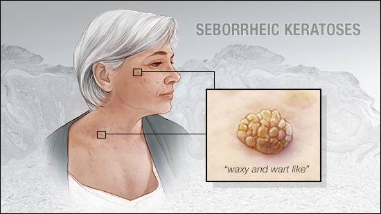 a medical illustration of seborrheic keratoses