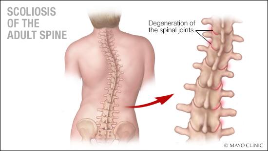 Mayo Clinic Q And A Scoliosis Most Often Develops During Growth Spurt 