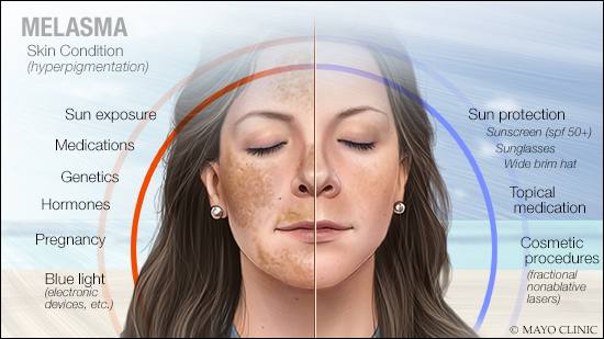 a medical illustration of melasma