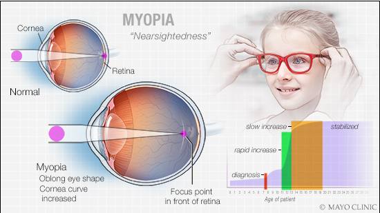 a medical illustration of myopia or nearsightedness