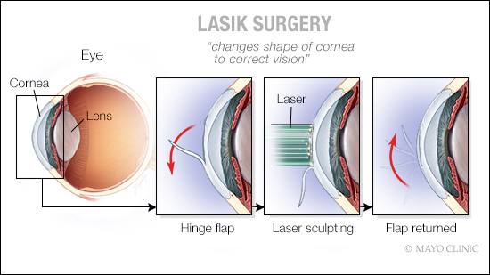 a medical illustration of LASIK surgery