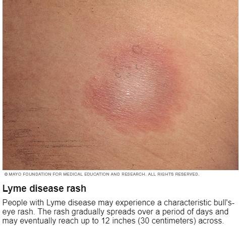 Lyme disease is caused by bacteria - Mayo Clinic News Network