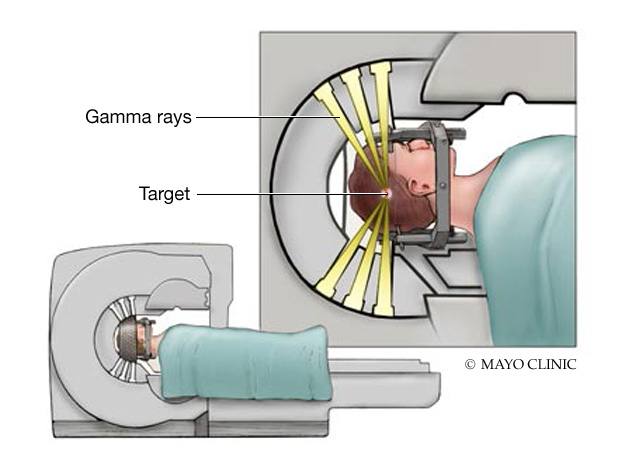 Advancements In Gamma Knife Radio Surgery Mayo Clinic News Network