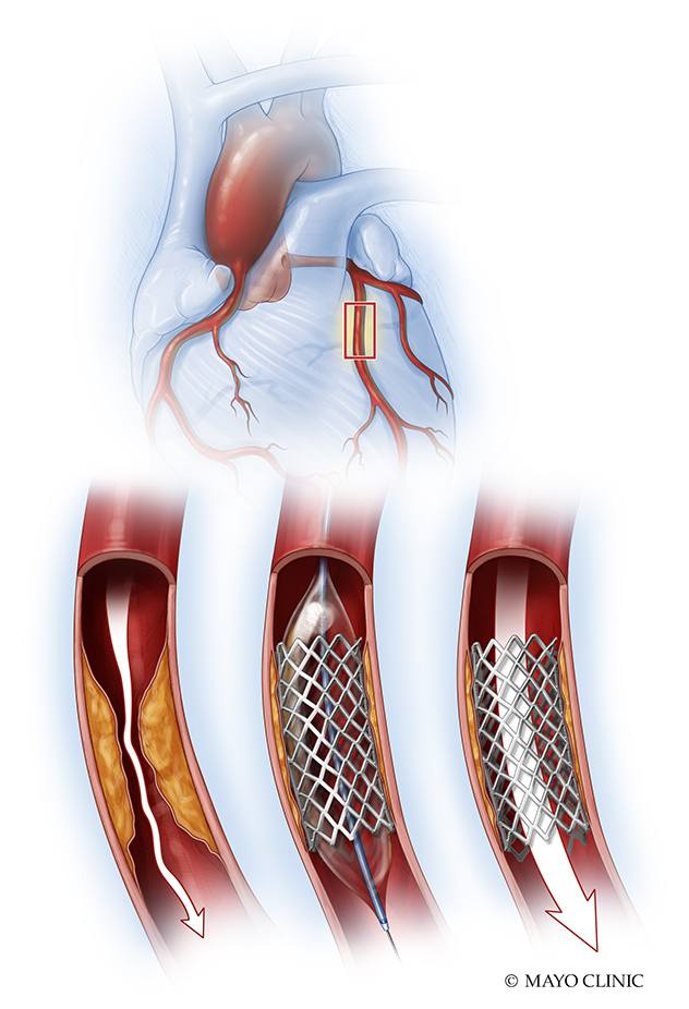 medical illustration of a coronary_artery_stent