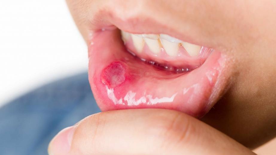 woman suffering from mouth aphtha canker sore on lip
