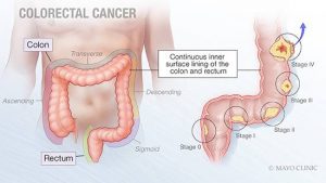You're at risk of colorectal cancer. Know the symptoms. Get screened ...