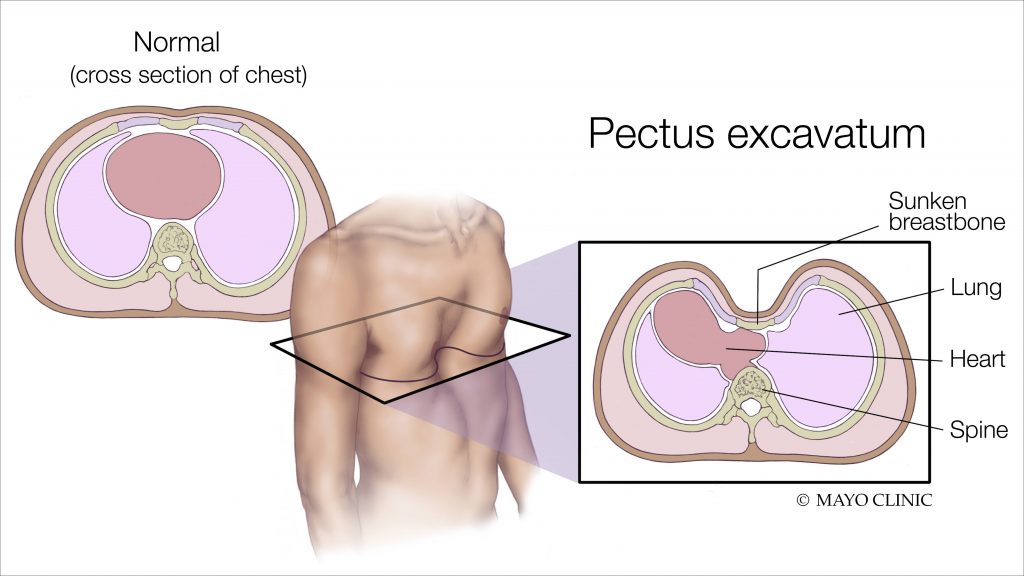 a medical illustration of pectus excavatum