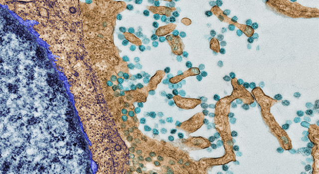 SARS-CoV-2 (puntos verde azulados) en la superficie de una célula Vero cultivada (el núcleo está abajo, a la izquierda). La imagen es cortesía del Centro de Microscopia y Análisis Celular de Mayo Clinic 