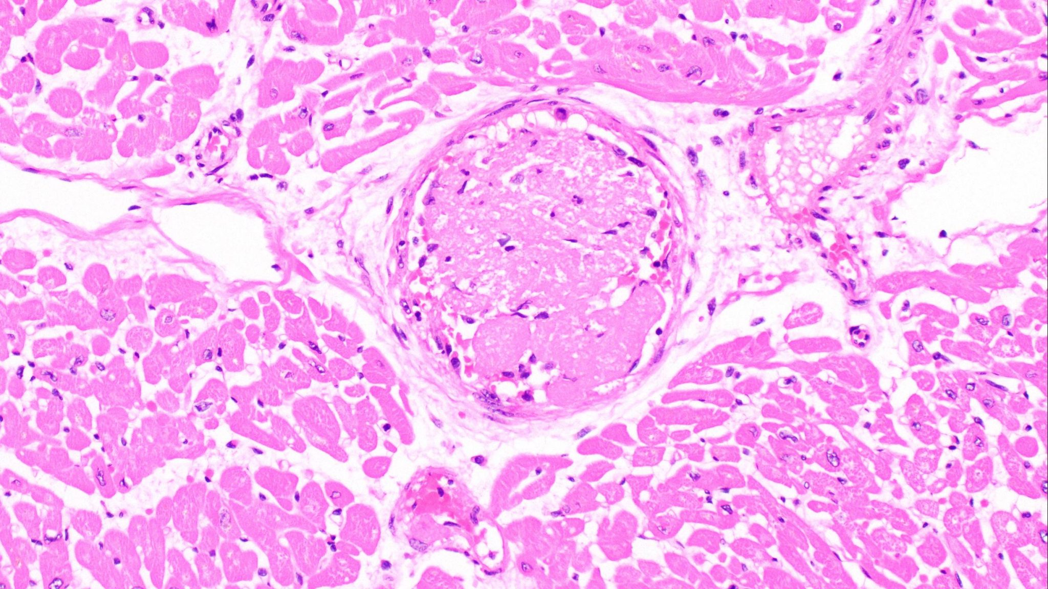 Blood clots in the heart are common in patients with COVID19 Mayo