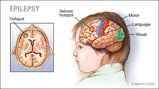 medical illustration of a brain with epilepsy; a seizure hotspot; and the motor, language and visual areas
