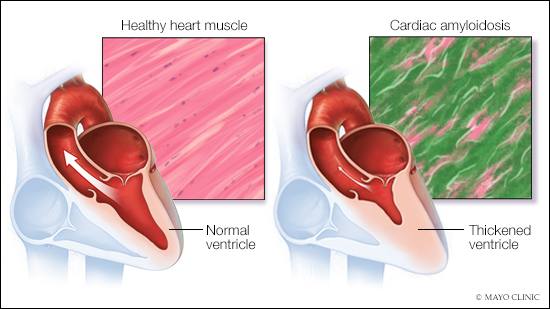 medical illustration of healthy heart muscle and a second heart with cardiac amyloidosis