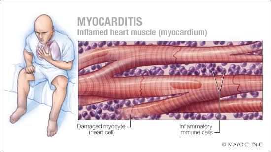 medical illustration depicting inflames heart muscle, heart cells involved with myocarditis