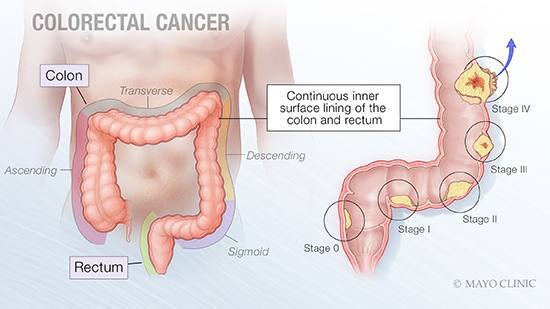 colon cancer stage 0