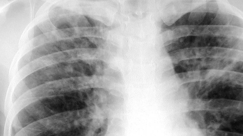 A lung X-ray of a Mayo Clinic patient with tuberculosis.