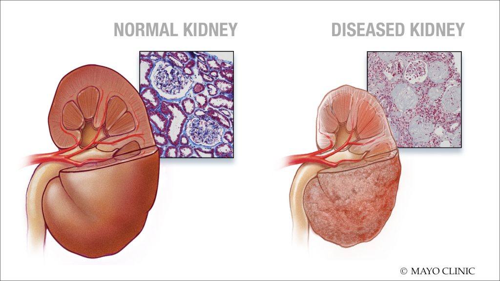 medical illustration of normal and diseased kidneys
