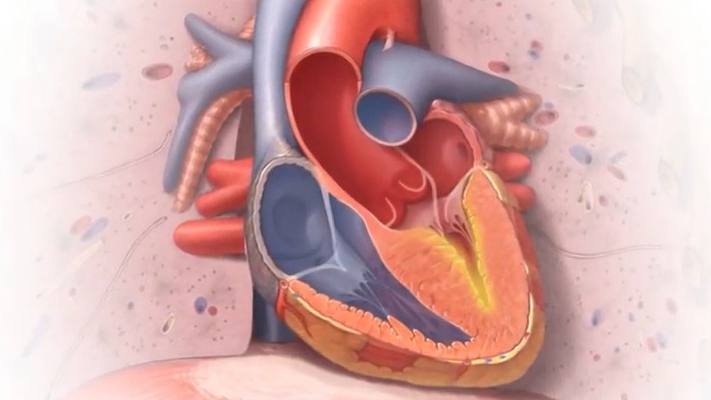 Ilustración médica de un corazón con miocardiopatía hipertrófica