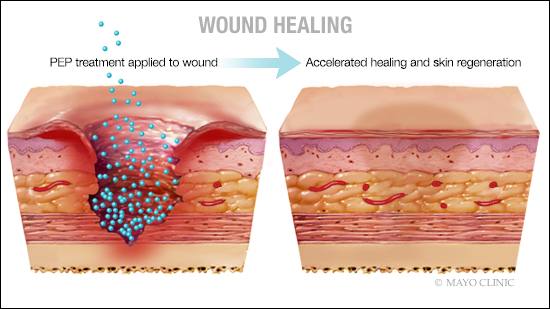 Quick Wound Healing Process with FIR Therapy