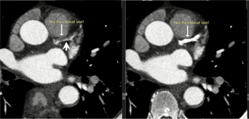 X-ray revealing intact portions of the coromary artery lumen / dense coronary calicifications