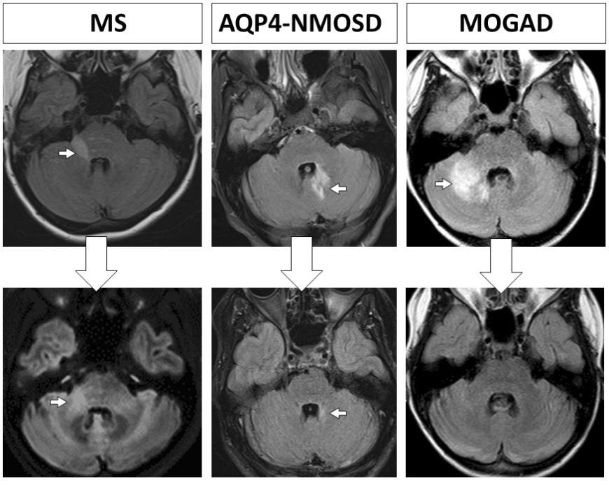 Brain MRIs show white spots, or lesions, occurring during an attack of MS, AQP4-NMOSD and MOGAD