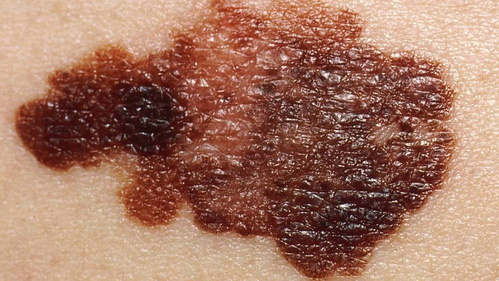 closeup of brown, cancerous mole, melanoma