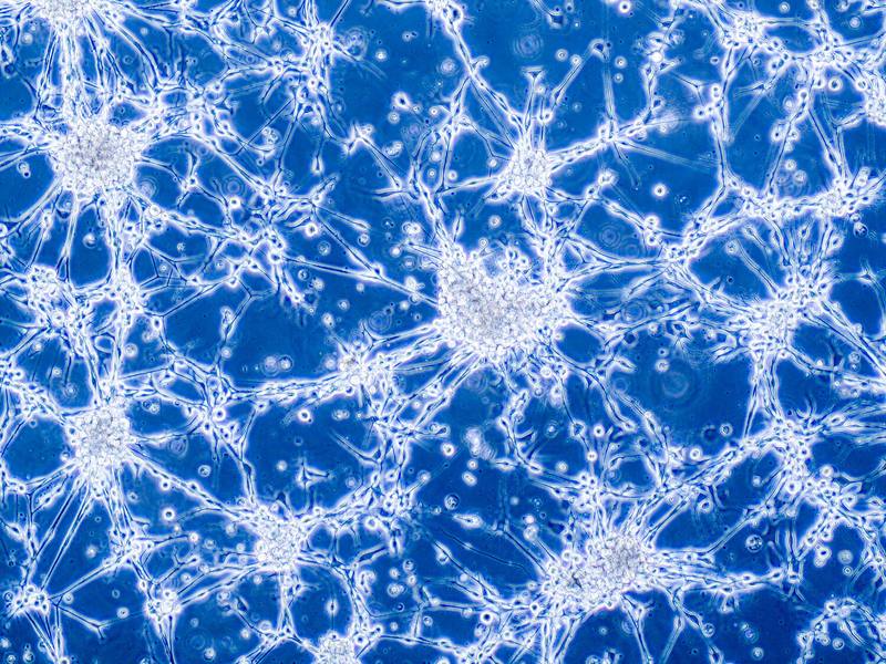 a microscopic slide of glioblastoma brain cancer cells
