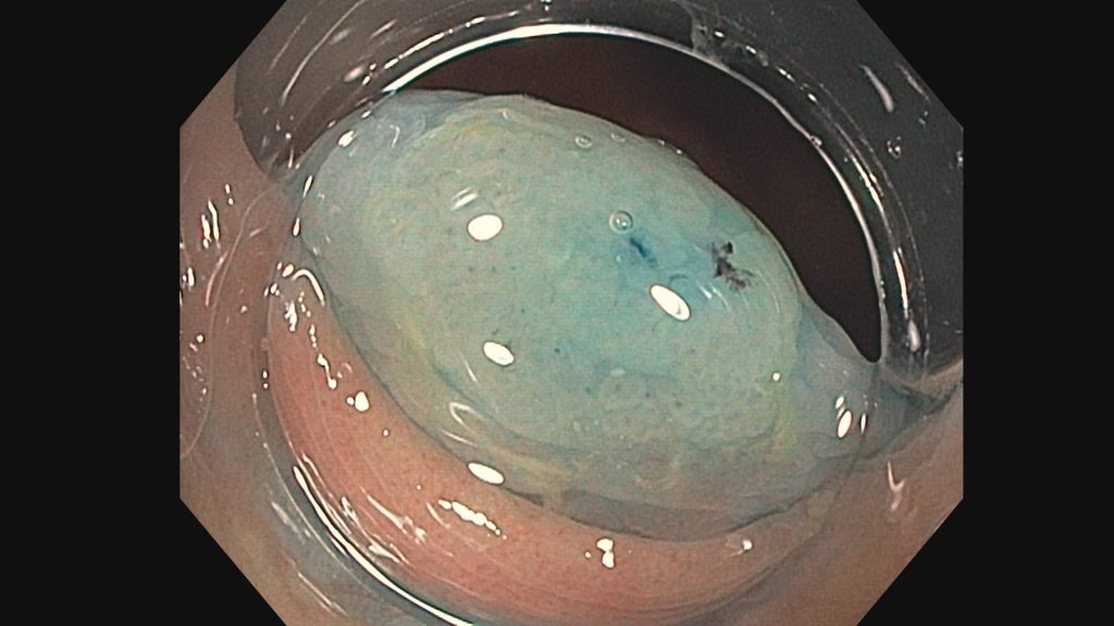 a serrated polyp injected with blue dye